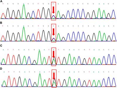 Clinical Characteristics and Genetic Analysis of a Family With Birt-Hogg-Dubé Syndrome and Congenital Contractural Arachnodactyly